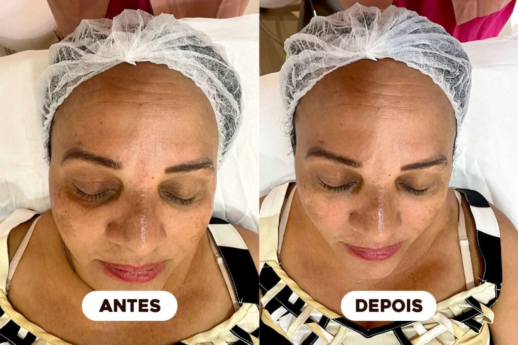 Corpo Studio - Procedimentos - Antes e depois