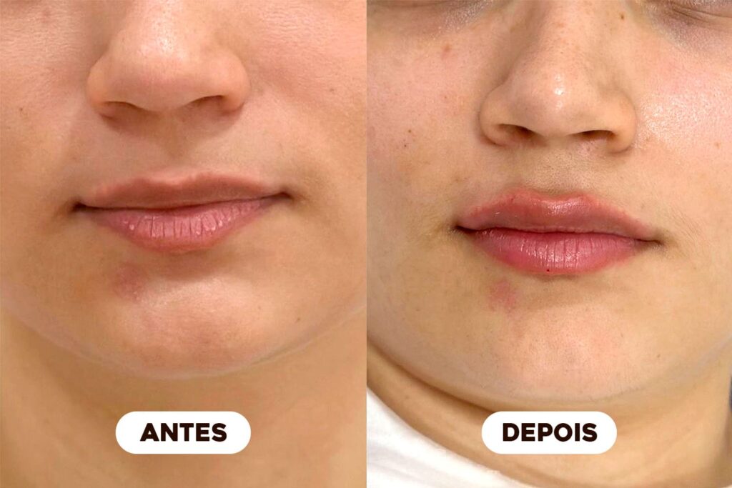 Corpo Studio - Procedimentos - Antes e depois